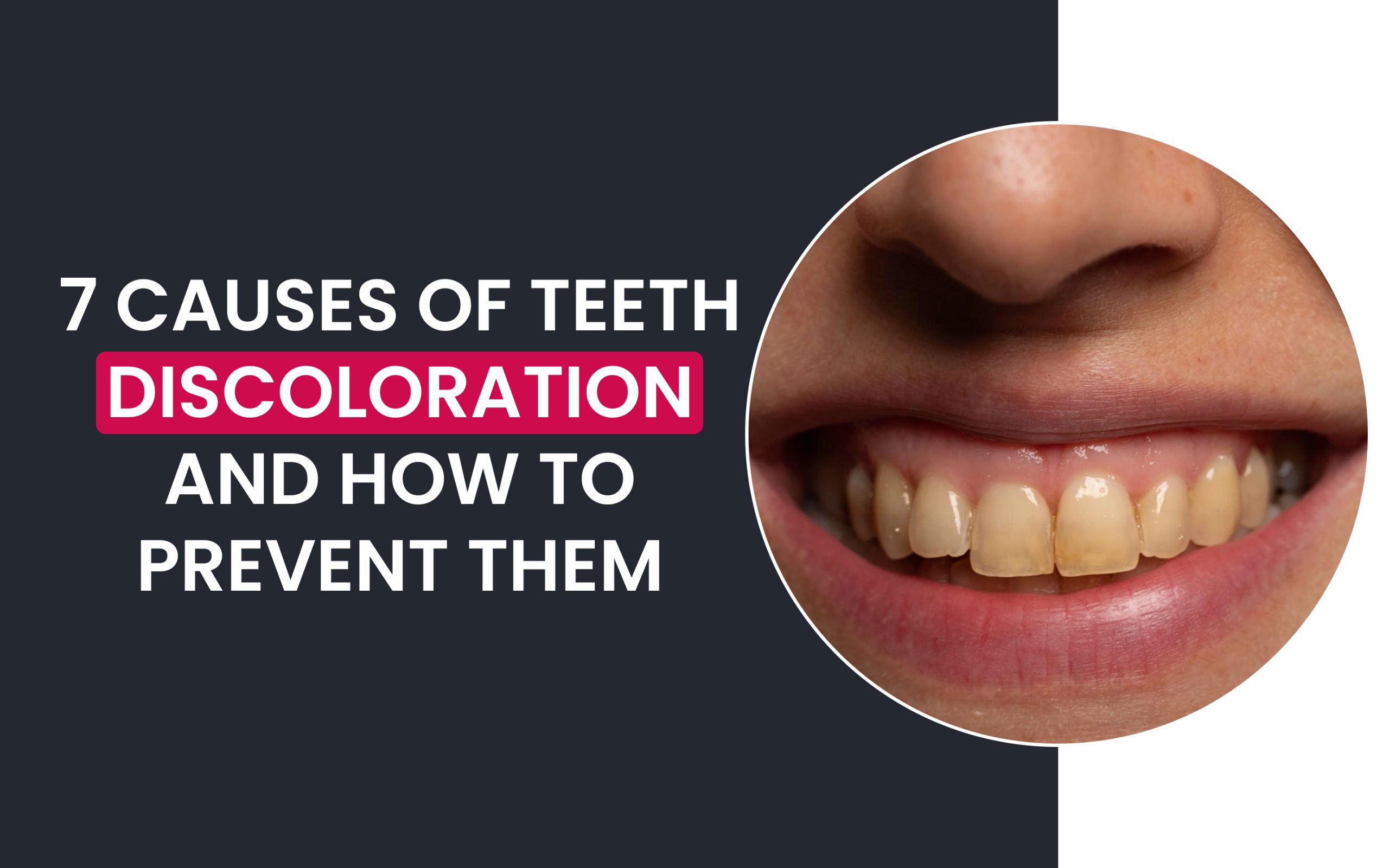 Causes of teeth discoloration