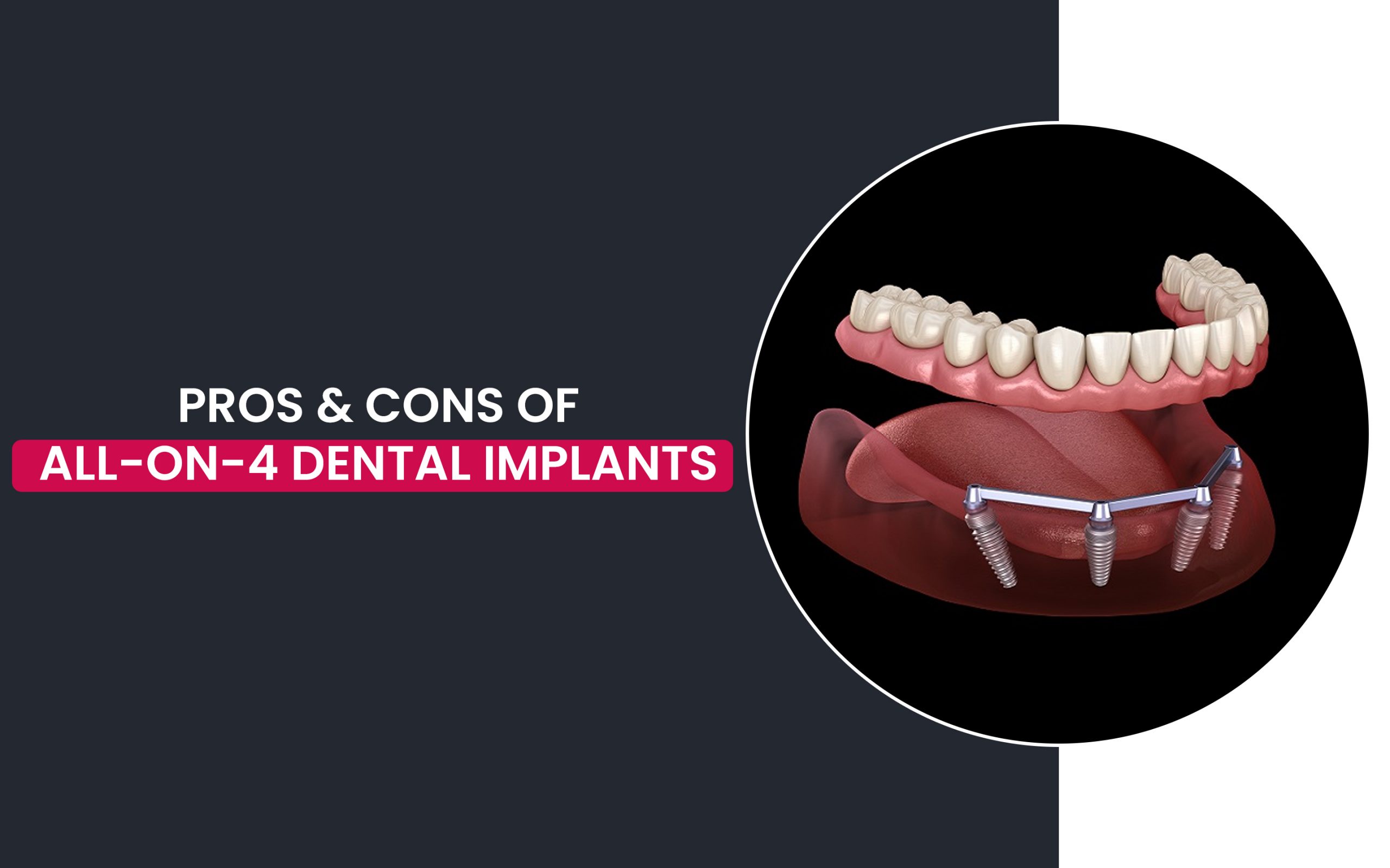 All on 4 dental implants pros and cons