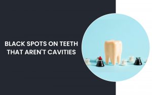 Black Spots On Teeth