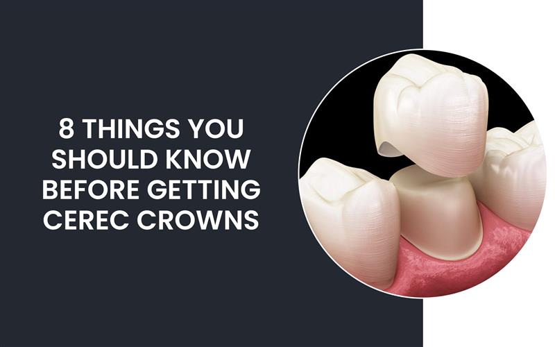 8 Things You Should Know Before Getting CEREC Crowns