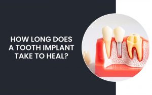 How Long Does A Tooth Implant Take To Heal