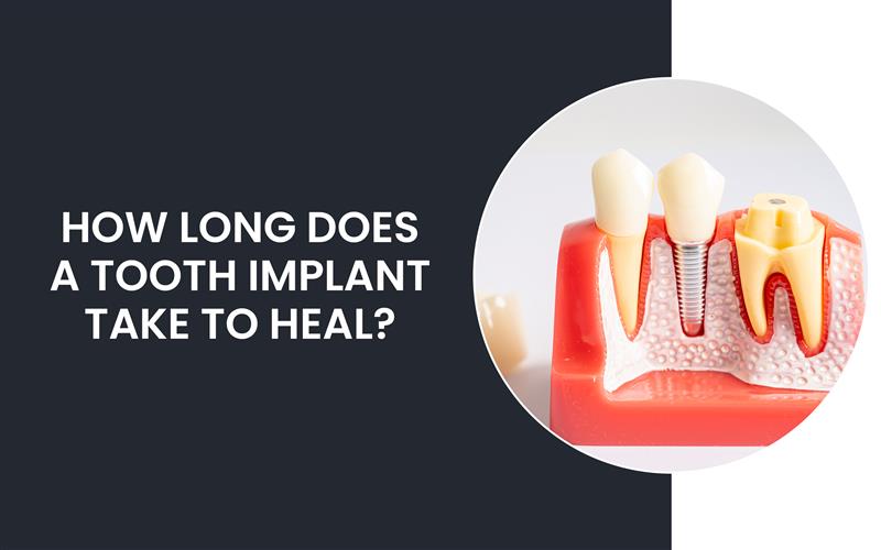 How Long Does A Tooth Implant Take To Heal