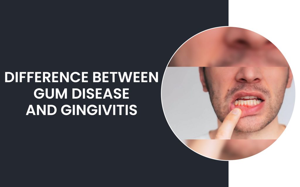 Difference Between Gum Disease And Gingivitis